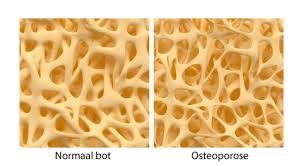 osteoporose2