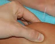 Dry Needling bij Fysiotherapie Rob Mars