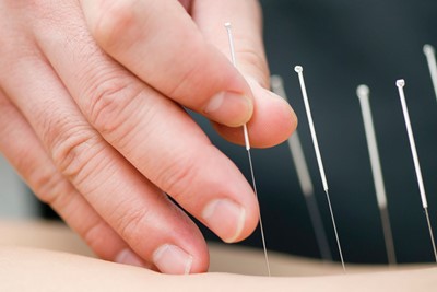 Dry Needling