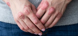 artritis psoriatica