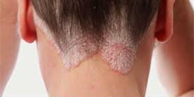 Psoriasis Vulgaris