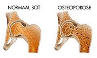 osteoporose