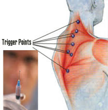 triggerpoints